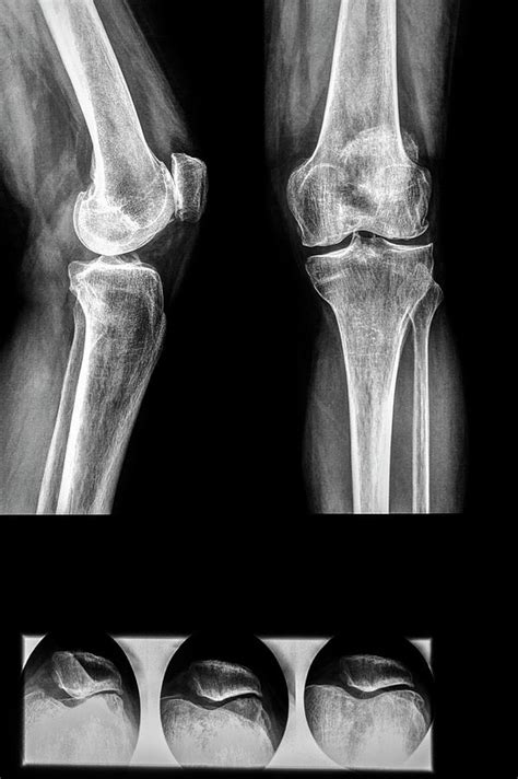 Diagnostic Knee And Knee-cap X-rays Photograph by Brian Gadsby/science ...