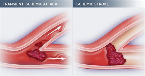 What Is a "Mini" Stroke?