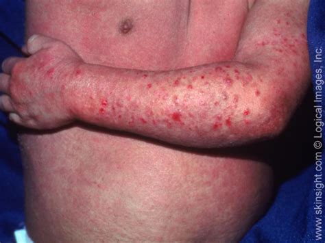 Eczema in Children | Atopic Dermatitis in Kids | Causes | Treatments ...