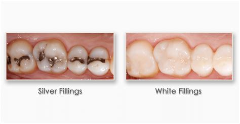 White Fillings Vs Silver Fillings Teeth - TeethWalls