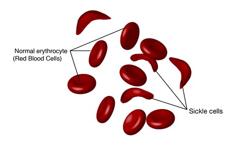 Sickle Cell Anemia - The Medical Biochemistry Page