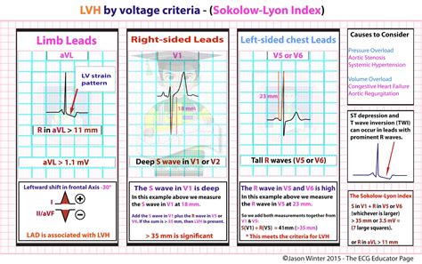 ECG Educator Blog : LVH by voltage criteria - (Sokolow-Lyon Index)