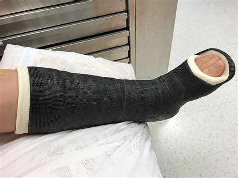 Ever Wonder How Hospitals Remove A Cast From A Leg? [VIDEO]