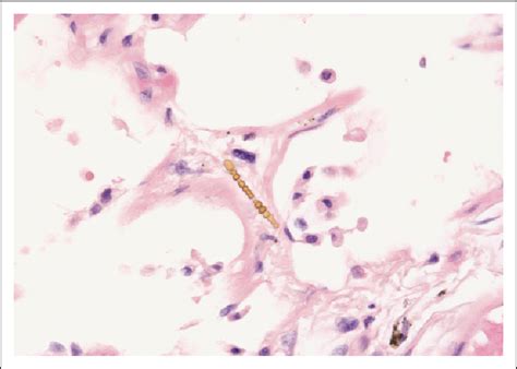 Asbestos body in the lung of a patient with asbestos exposure. Note the ...