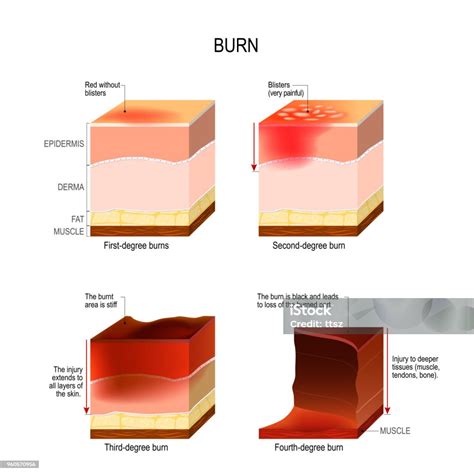 Skin Burn Four Degrees Of Burns Stock Illustration - Download Image Now ...