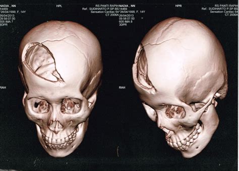 Patient CT scan results. [10] | Download Scientific Diagram