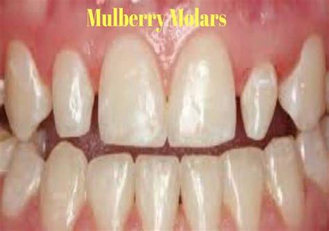 Mulberry Molars: About, Symptoms, Causes and Treatment