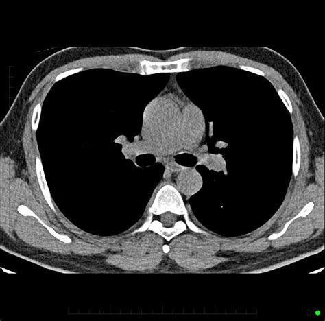 Chest CT Scan - Melbourne Radiology