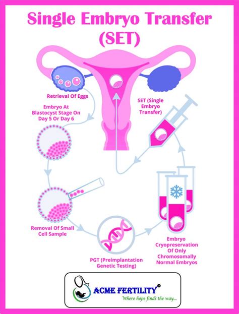 Single Embryo Transfer (SET) – IVF Blogs