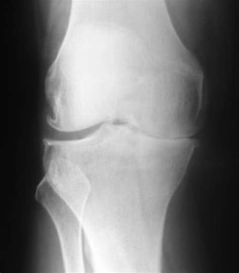 Knee X-ray - Understanding the signs of Arthritis | HubPages