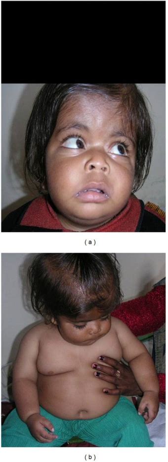 MOMO syndrome - WikiProjectMed