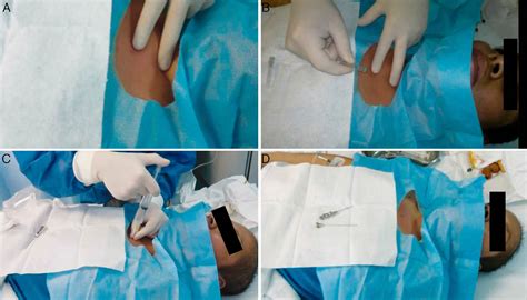 Bone Marrow Biopsy - Reasons, Pain, Complications