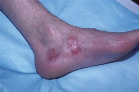 Prevalence of Psoriatic Arthritis Quantified in Patients With Psoriasis ...