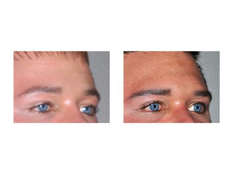 brow bone augmentation Archives