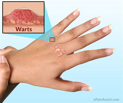 Warts|Causes|Symptoms|Investigations|Treatment-Conservative ...