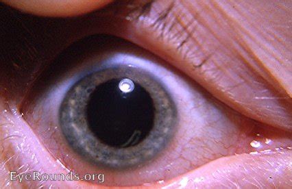 Brushfield's spots in a normal adult. EyeRounds.org: Online Ophthalmic ...