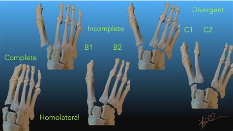 Lisfranc Injuries | UW Emergency Radiology