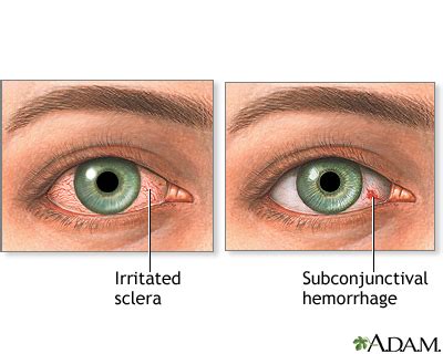 Bloodshot eyes: MedlinePlus Medical Encyclopedia Image