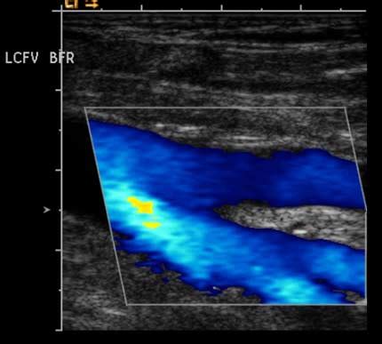 Venous Ultrasound