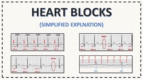 Different Types Of Heart Blocks