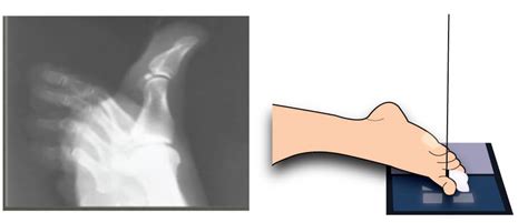 X-Ray Positioning Guide: Toes | Medical Professionals