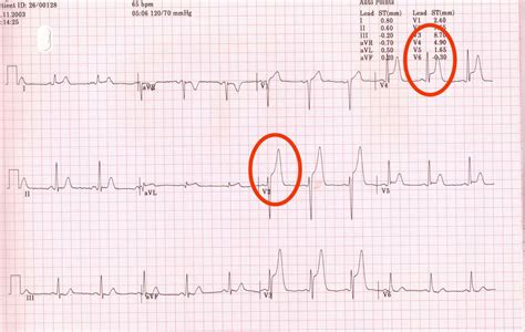 Ekg Practice Worksheets