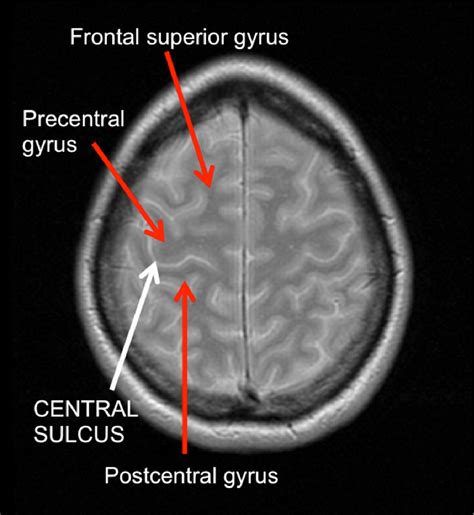 Postcentral Gyrus Mri