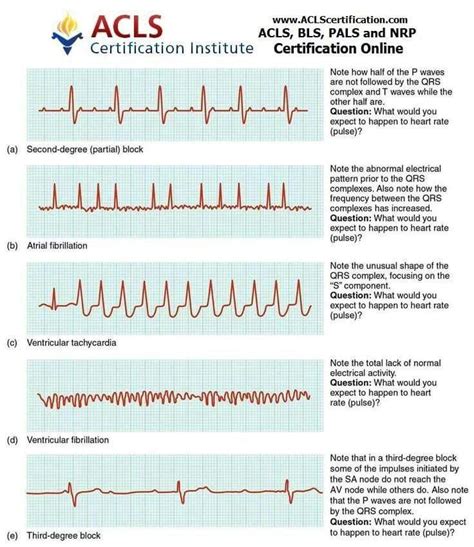 Ekg Practice Strips Printable Users Are Asked To Identify The ...