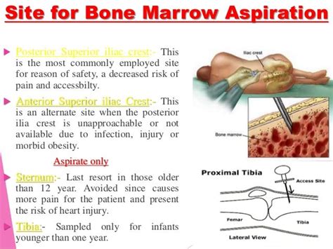 Posterior Iliac Crest Bone Marrow Biopsy