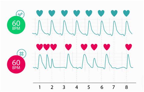 Dysrhythmia Are Used to Describe Abnormal Heart Rhythm