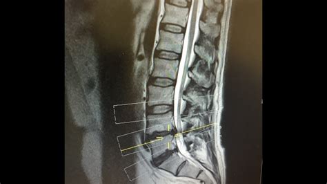 Day 6 after L4/L5 Microdiscectomy Lumbar Back Surgery for Slipped ...