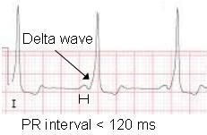 Wolff-Parkinson-White (WPW) Syndrome ECG Review - Criteria and Examples ...