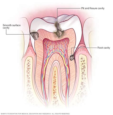 Caries dentarias - Diagnóstico y tratamiento - Mayo Clinic