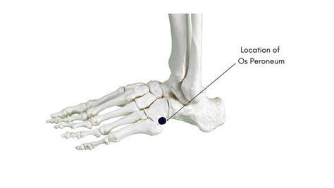 Os Peroneum Syndrome: Get the Answers from a Foot Specialist