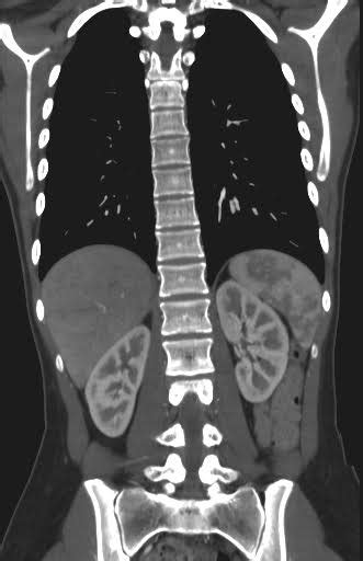 Thoracic Spine Ct Scan