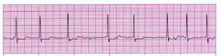 Atrial Fibrillation (A Fib) | CardiacMonitoring.com