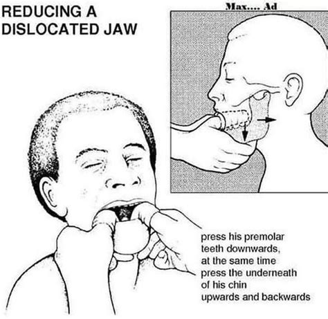 Reduction of Jaw Dislocation - MEDizzy