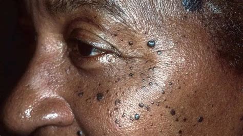 Seborrheic keratosis: Causes, symptoms, diagnosis and treatment ...