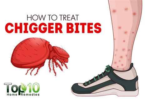 How to Treat Chigger Bites | Top 10 Home Remedies