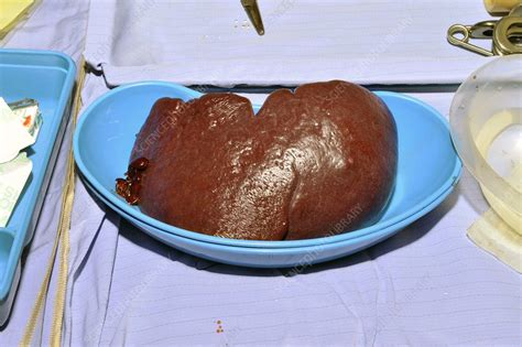 Spleen removal surgery - Stock Image - C001/8179 - Science Photo Library