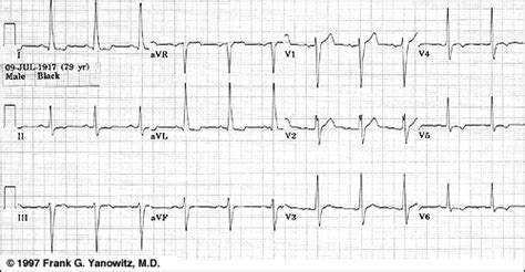 ECG Learning Center - An introduction to clinical electrocardiography