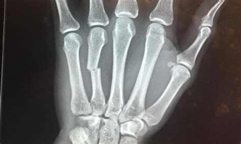 Cezar Ferreira posts X-ray of hand broken on ‘first punch I connected ...