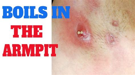 Boil in armpit | Symptoms of boil in armpit | Arm pit pus | Underarm ...