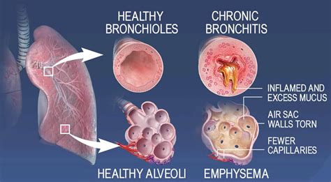 Emphysema Causes, Symptoms, Diagnosis, Treatment