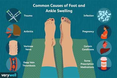 Common Causes of Foot and Ankle Swelling