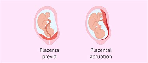 Complications in pregnancy due to problems in the placenta