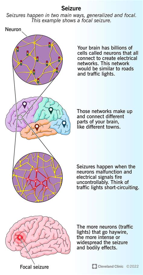 Understanding Epilepsy: Causes, Symptoms, And Treatment - Ask The Nurse ...