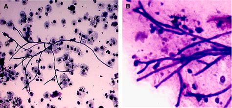 Figure 1 from Aspergillus infections in the critically ill. | Semantic ...