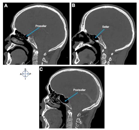 Sphenoid Sinus Pneumatization Types Radiology