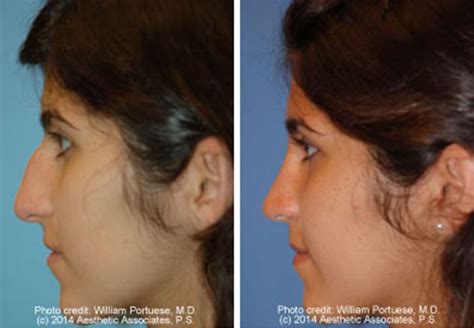 Ethnic Rhinoplasty Surgery in Seattle WA